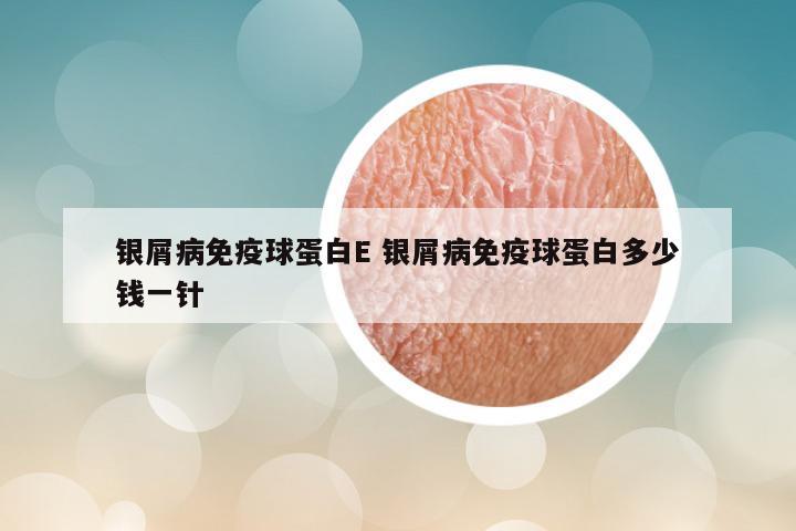 银屑病免疫球蛋白E 银屑病免疫球蛋白多少钱一针