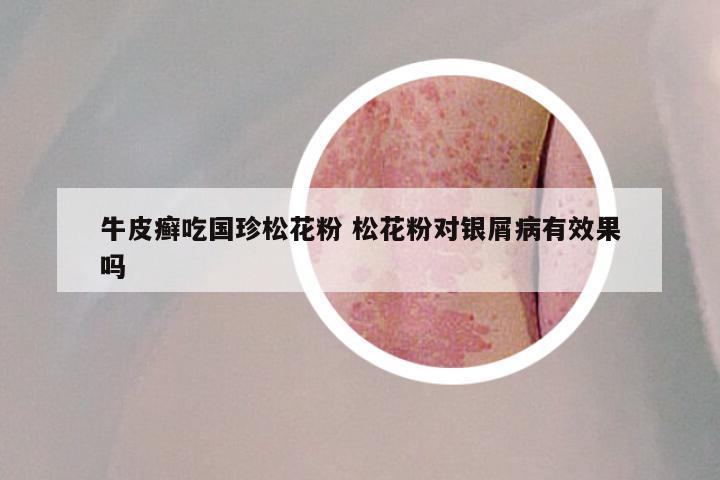 牛皮癣吃国珍松花粉 松花粉对银屑病有效果吗