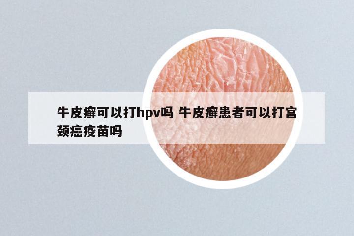 牛皮癣可以打hpv吗 牛皮癣患者可以打宫颈癌疫苗吗