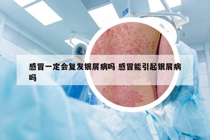 感冒一定会复发银屑病吗 感冒能引起银屑病吗