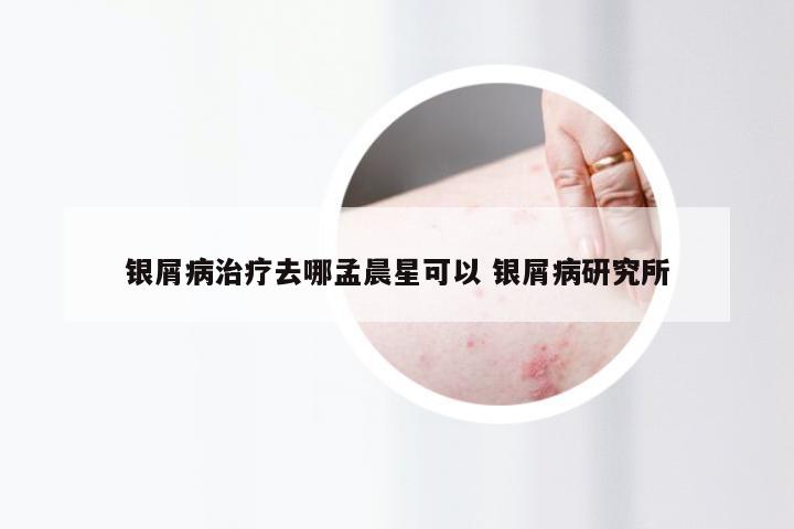 银屑病治疗去哪孟晨星可以 银屑病研究所