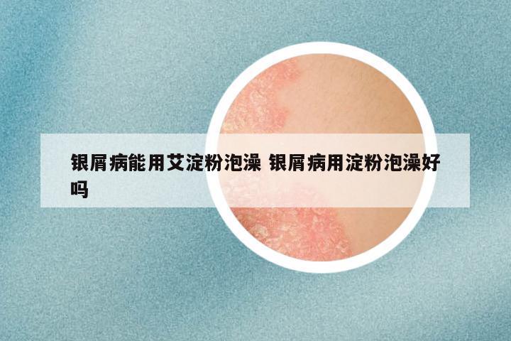 银屑病能用艾淀粉泡澡 银屑病用淀粉泡澡好吗