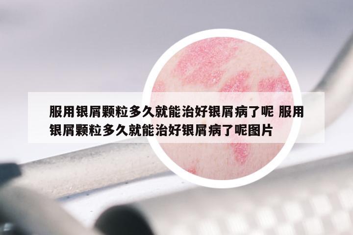 服用银屑颗粒多久就能治好银屑病了呢 服用银屑颗粒多久就能治好银屑病了呢图片