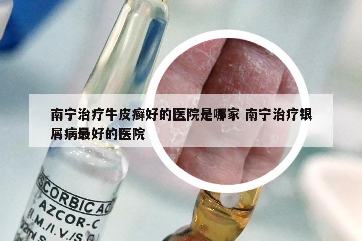 南宁治疗牛皮癣好的医院是哪家 南宁治疗银屑病最好的医院
