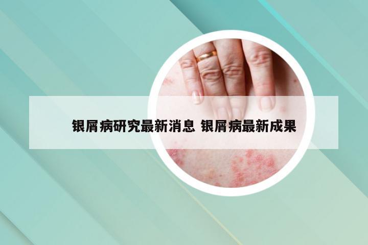 银屑病研究最新消息 银屑病最新成果