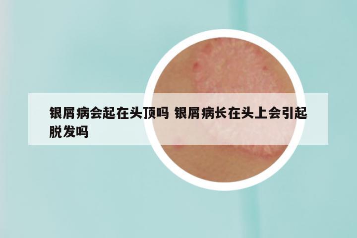 银屑病会起在头顶吗 银屑病长在头上会引起脱发吗