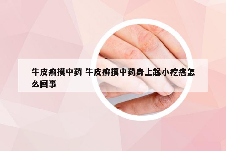 牛皮癣摸中药 牛皮癣摸中药身上起小疙瘩怎么回事