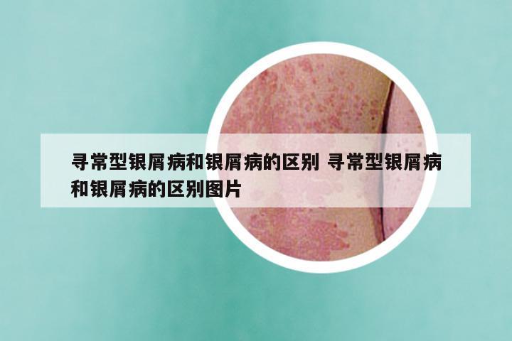 寻常型银屑病和银屑病的区别 寻常型银屑病和银屑病的区别图片