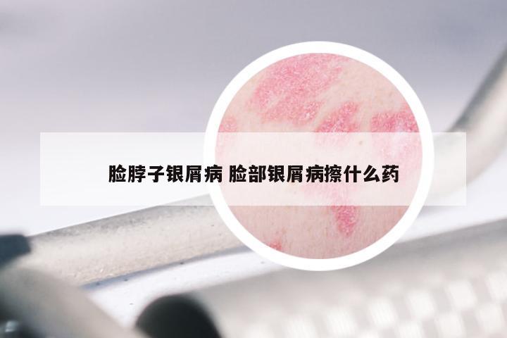 脸脖子银屑病 脸部银屑病擦什么药