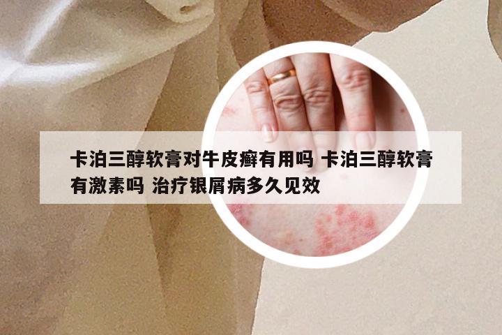 卡泊三醇软膏对牛皮癣有用吗 卡泊三醇软膏有激素吗 治疗银屑病多久见效