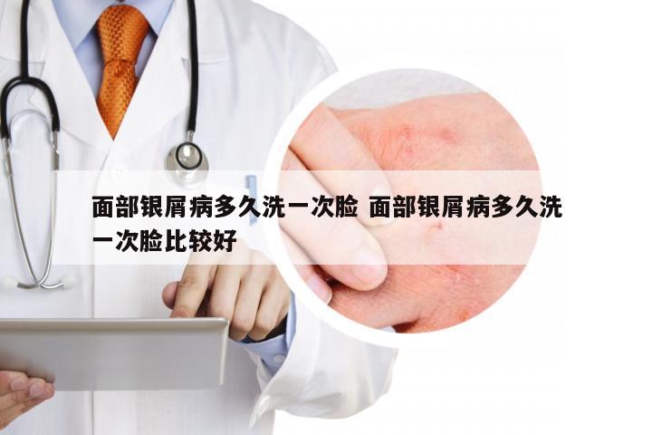 面部银屑病多久洗一次脸 面部银屑病多久洗一次脸比较好