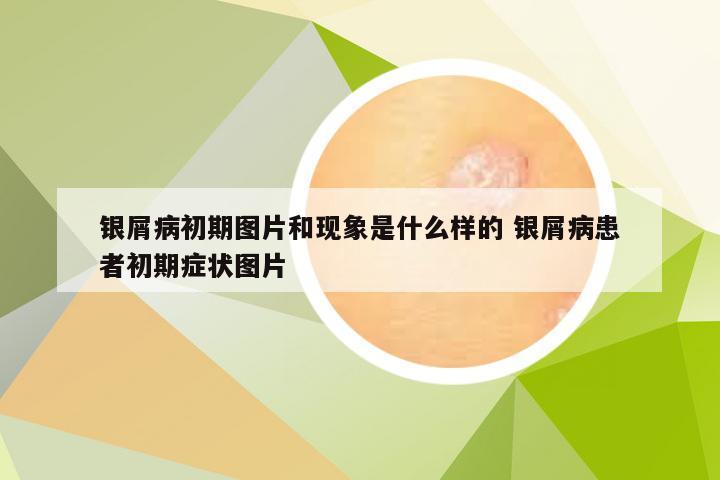 银屑病初期图片和现象是什么样的 银屑病患者初期症状图片