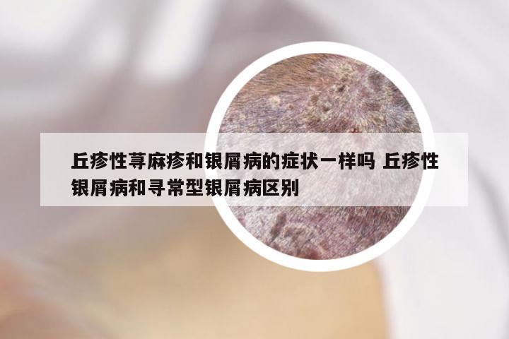 丘疹性荨麻疹和银屑病的症状一样吗 丘疹性银屑病和寻常型银屑病区别