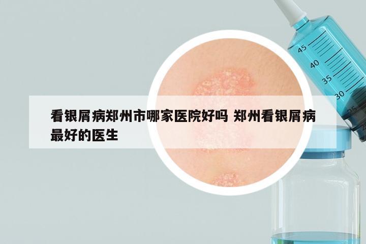 看银屑病郑州市哪家医院好吗 郑州看银屑病最好的医生