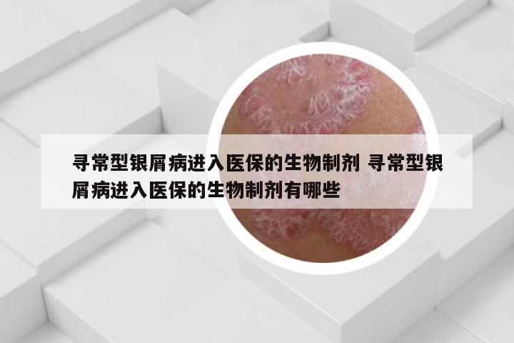 寻常型银屑病进入医保的生物制剂 寻常型银屑病进入医保的生物制剂有哪些