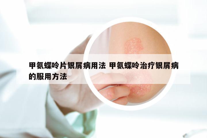 甲氨蝶呤片银屑病用法 甲氨蝶呤治疗银屑病的服用方法