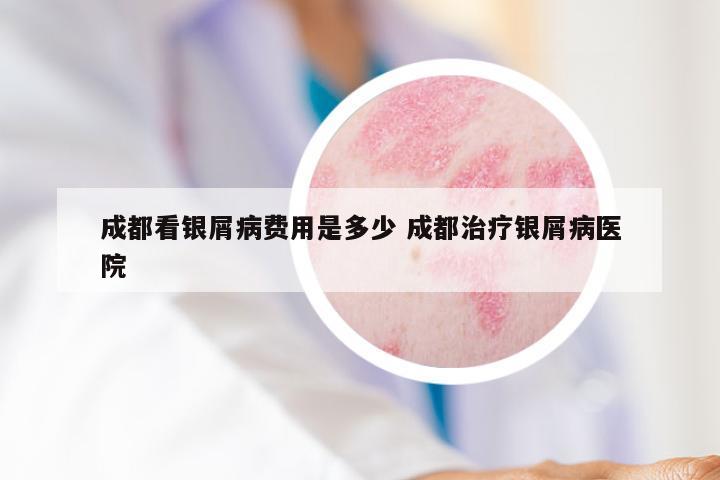 成都看银屑病费用是多少 成都治疗银屑病医院