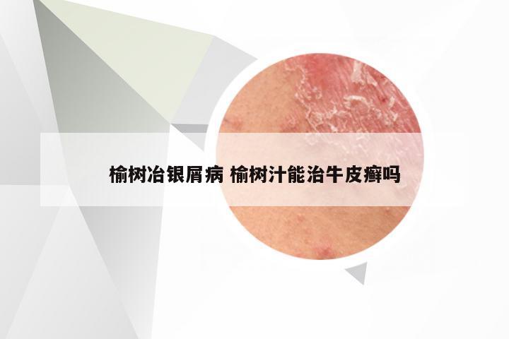 榆树冶银屑病 榆树汁能治牛皮癣吗