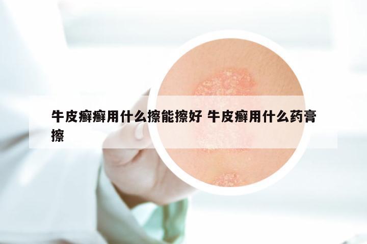 牛皮癣癣用什么擦能擦好 牛皮癣用什么药膏擦