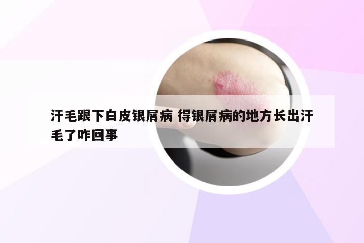 汗毛跟下白皮银屑病 得银屑病的地方长出汗毛了咋回事