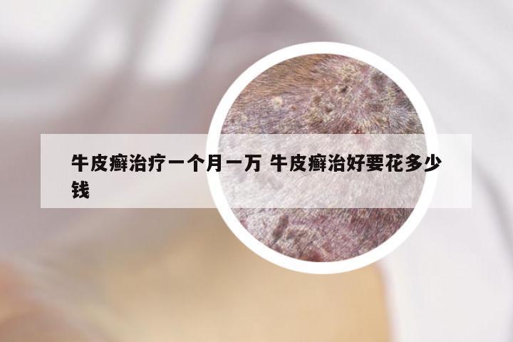 牛皮癣治疗一个月一万 牛皮癣治好要花多少钱