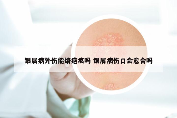 银屑病外伤能烙疤痕吗 银屑病伤口会愈合吗