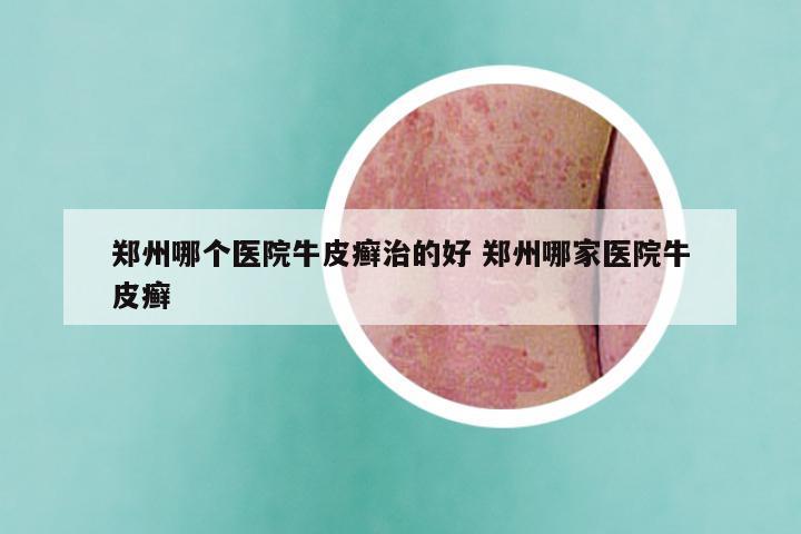 郑州哪个医院牛皮癣治的好 郑州哪家医院牛皮癣