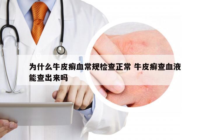 为什么牛皮癣血常规检查正常 牛皮癣查血液能查出来吗