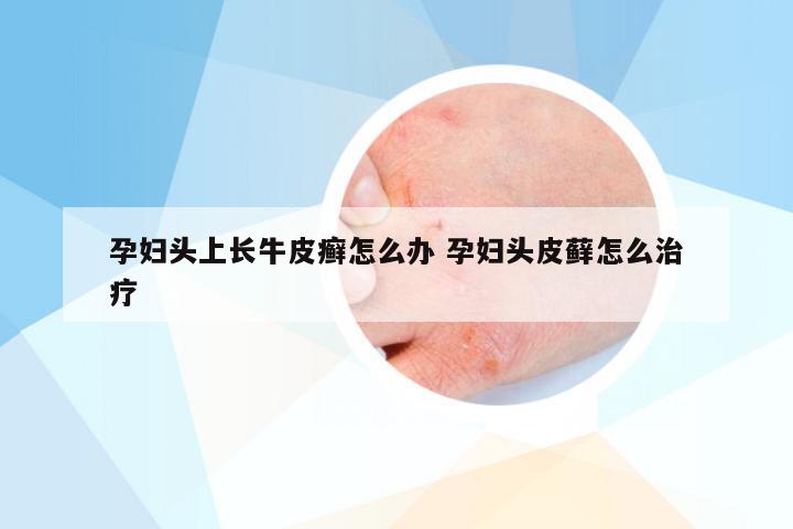 孕妇头上长牛皮癣怎么办 孕妇头皮藓怎么治疗