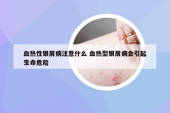 血热性银屑病注意什么 血热型银屑病会引起生命危险