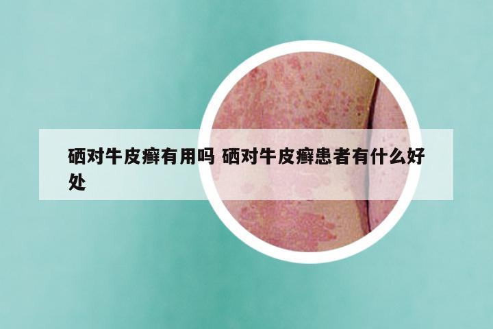 硒对牛皮癣有用吗 硒对牛皮癣患者有什么好处