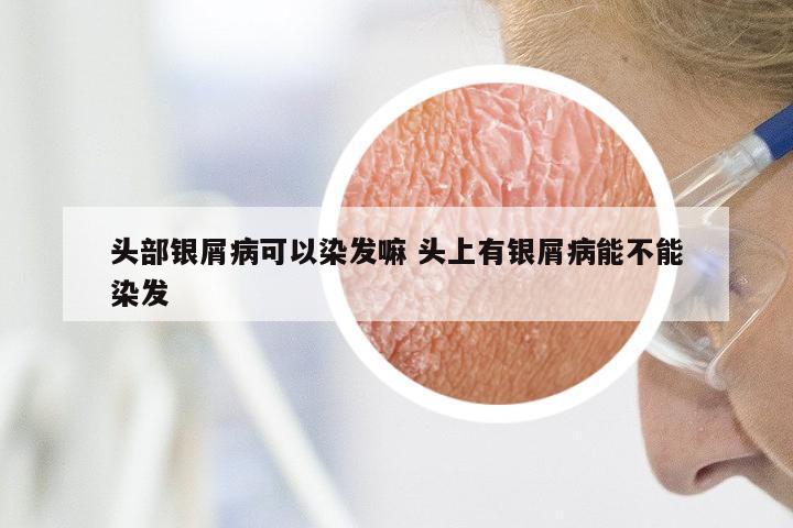 头部银屑病可以染发嘛 头上有银屑病能不能染发