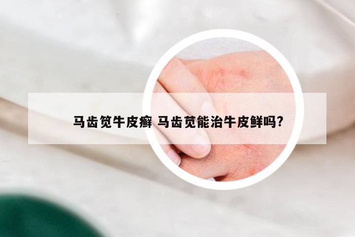 马齿笕牛皮癣 马齿苋能治牛皮鲜吗?