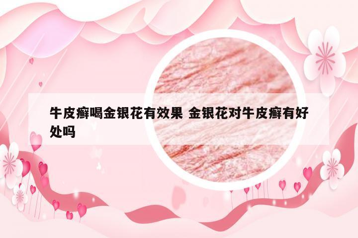 牛皮癣喝金银花有效果 金银花对牛皮癣有好处吗