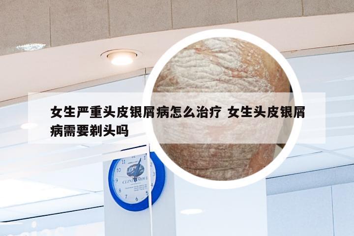 女生严重头皮银屑病怎么治疗 女生头皮银屑病需要剃头吗