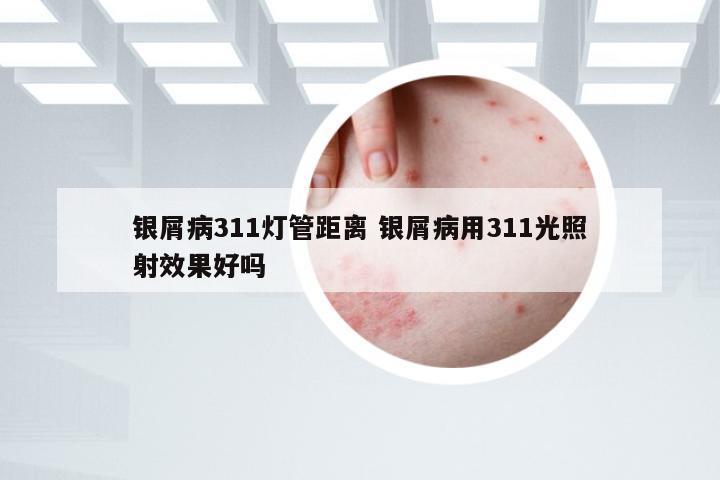 银屑病311灯管距离 银屑病用311光照射效果好吗