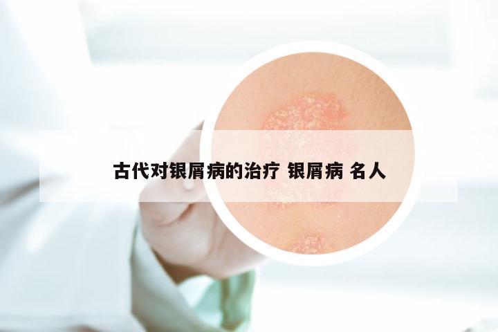 古代对银屑病的治疗 银屑病 名人