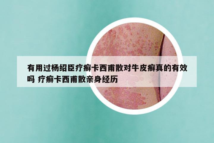 有用过杨绍臣疗癣卡西甫散对牛皮癣真的有效吗 疗癣卡西甫散亲身经历