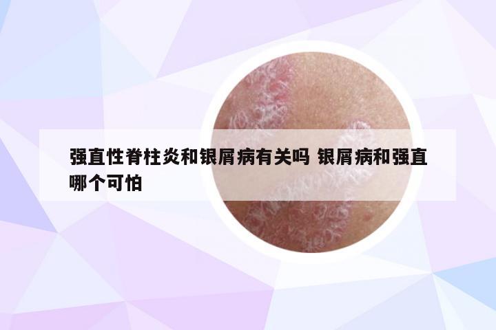 强直性脊柱炎和银屑病有关吗 银屑病和强直哪个可怕