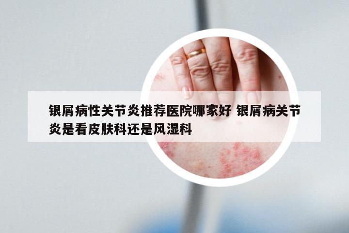 银屑病性关节炎推荐医院哪家好 银屑病关节炎是看皮肤科还是风湿科