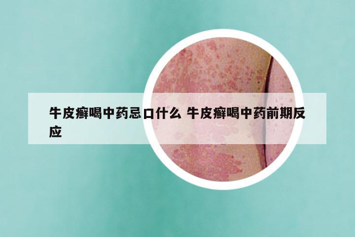 牛皮癣喝中药忌口什么 牛皮癣喝中药前期反应