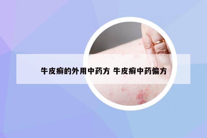 牛皮癣的外用中药方 牛皮癣中药偏方