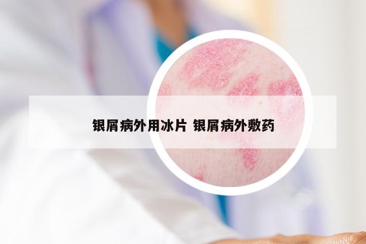 银屑病外用冰片 银屑病外敷药