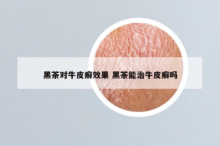 黑茶对牛皮癣效果 黑茶能治牛皮癣吗