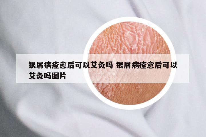 银屑病痊愈后可以艾灸吗 银屑病痊愈后可以艾灸吗图片