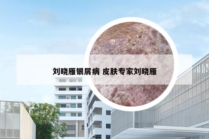 刘晓雁银屑病 皮肤专家刘晓雁