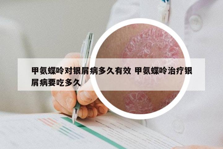 甲氨蝶呤对银屑病多久有效 甲氨蝶呤治疗银屑病要吃多久