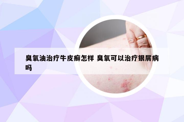 臭氧油治疗牛皮癣怎样 臭氧可以治疗银屑病吗