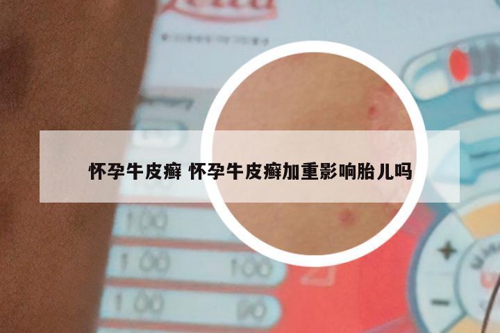 怀孕牛皮癣 怀孕牛皮癣加重影响胎儿吗