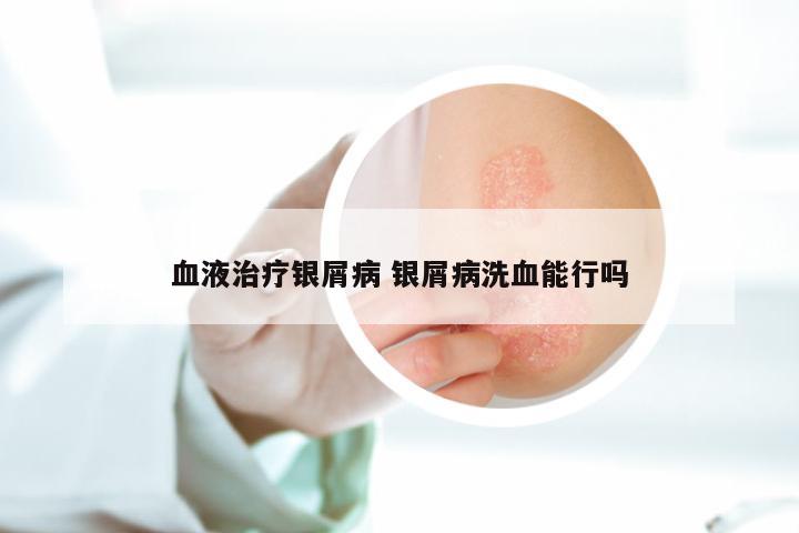 血液治疗银屑病 银屑病洗血能行吗